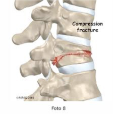 Osteoporose