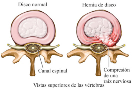 hernia-discal