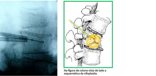 Cifoplastia