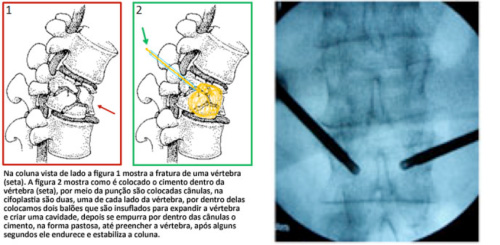 Cifoplastia