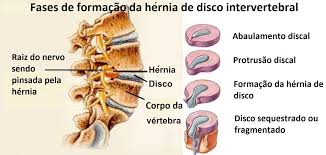 Tipos de Hernia de Disco