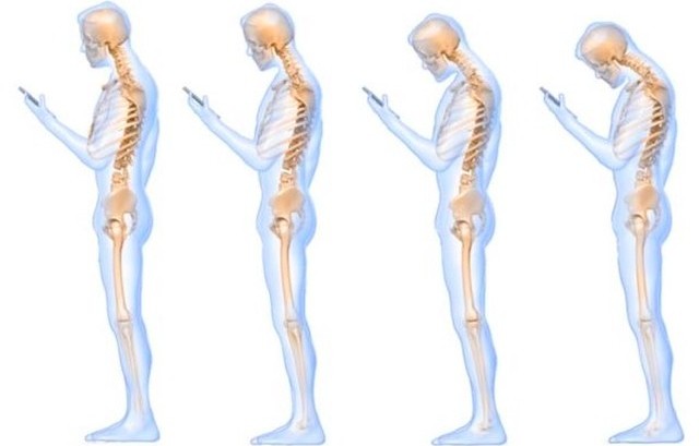 Cervicalgia e Smartphone