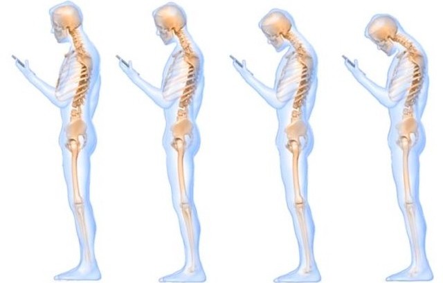 Cervicalgia e Smartphone