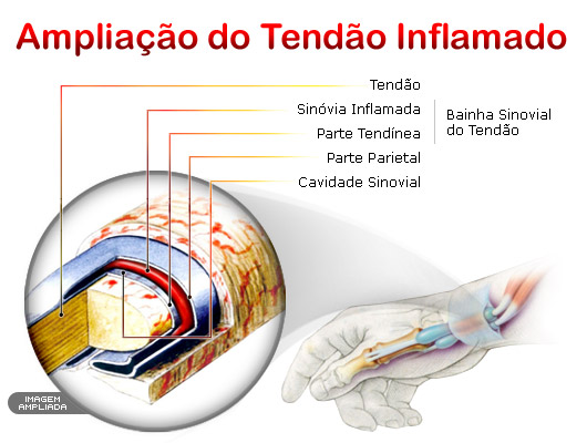 Distúrbios Ósteomusculares Relacionados ao Trabalho (DORT/LER): Ênfase para Dor em Coluna Vertebral