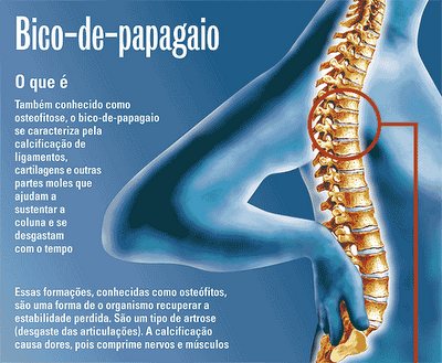 Bico de papagaio ou osteófito na coluna vertebral