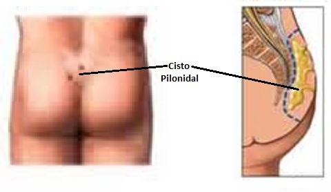 Cisto pilonidal: o que é, sintomas e cirurgia