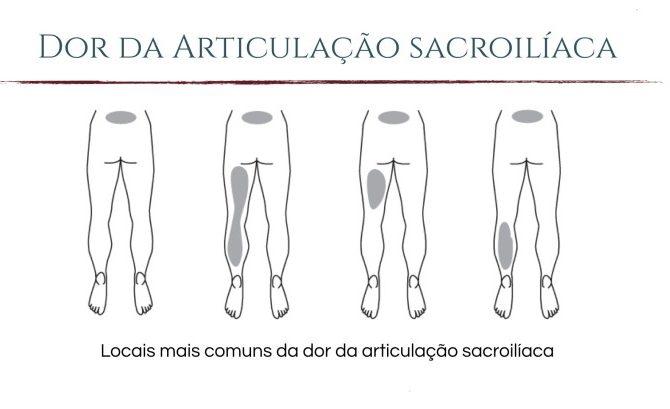 Dor na articulação Sacroilíca: Entenda mais