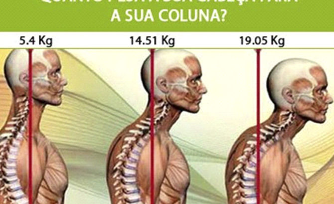 Corcunda na Coluna Cervical: Causas e Tratamento