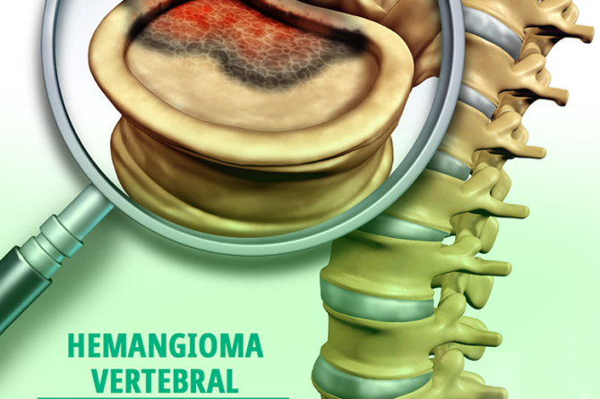 Você sabia que Hemangioma Vertebral tem tratamento?