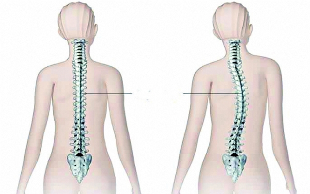 O que é Escoliose?