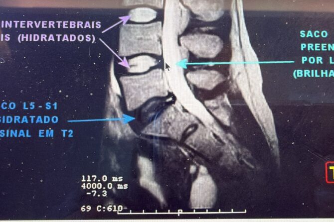Disco Desidratado na Coluna: O Que É, Sintomas e O Que Fazer