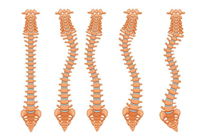 Escoliose: Guia Completo — O Que É, Tipos, Sintomas e Todo o Tratamento