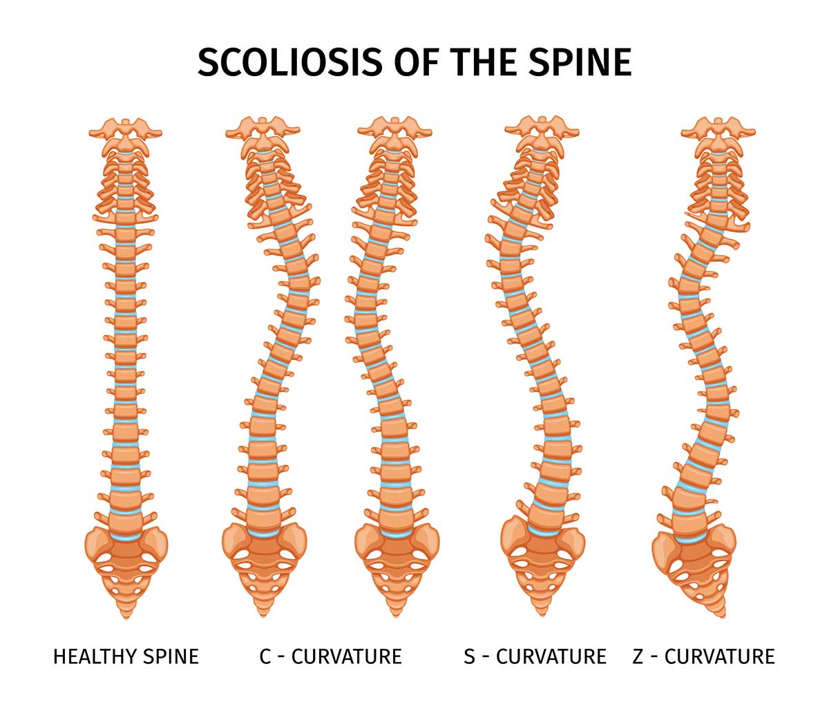 Ilustração médica mostrando os tipos de escoliose: curva em C (dextroescoliose e levoescoliose) e curva em S (escoliose dupla), vista posterior da coluna vertebral